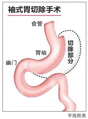 20180305_news_gastrectomy_Small.jpg