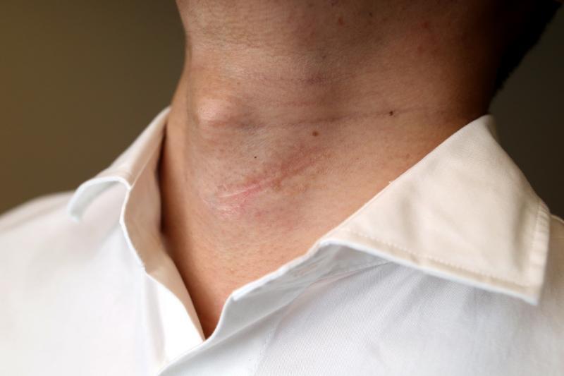 18年前的这一刀，几乎让卓汉隆丢了命，也让他改邪归正。