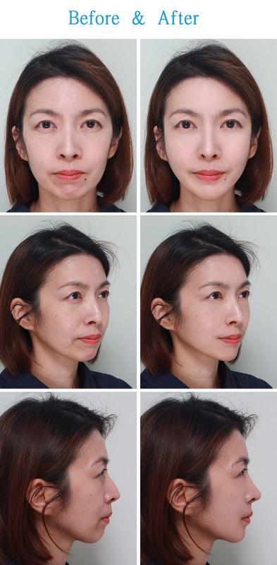 整形医生为记者做的电脑构图，左图为“修复”前。