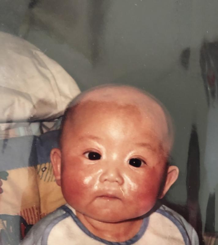 杨静睿小时候患有湿疹。(受访者提供)