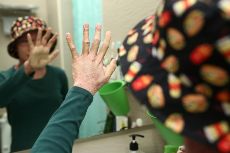 皮肤病严重时,杨静睿很害怕洗手和洗澡。(陈斌勤摄)