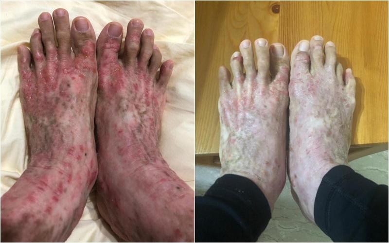 杨静睿皮肤病发作前(左)与康复后的对比。(受访者提供)