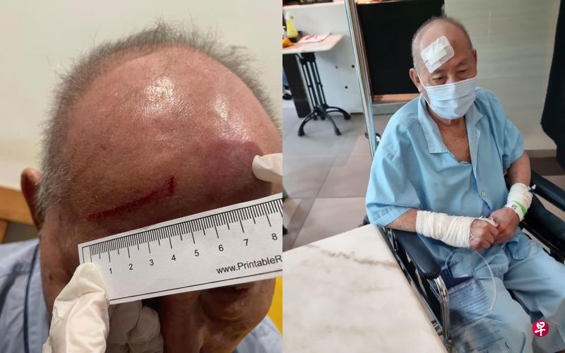 (左图)父亲额头上有一道4.5公分长的刮痕。(右图)林亚峇目前还需留院观察。(受访者提供) (左图)父亲额头上有一道4.5公分长的刮痕。(右图)林亚峇目前还需留院观察。(受访者提供)