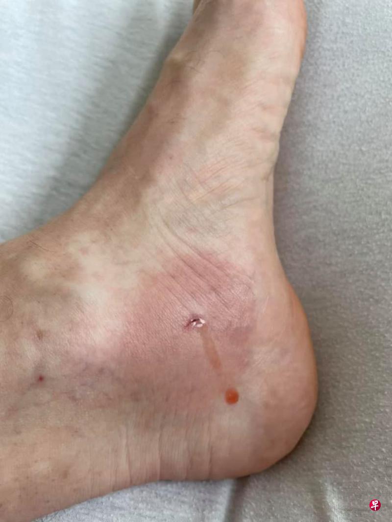 本杰明的脚踝被魔鬼鱼刺伤,在医院住了三天。 本杰明的脚踝被魔鬼鱼刺伤,在医院住了三天。