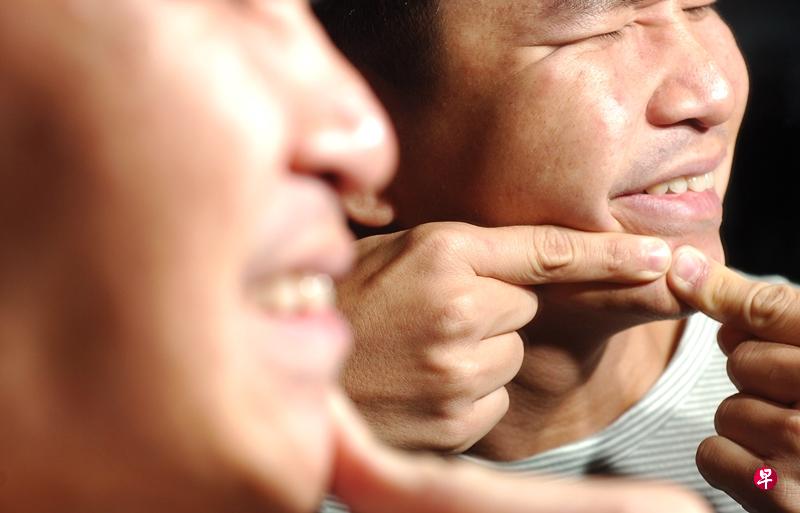 青春痘千万别挤压。(档案照) 青春痘千万别挤压。(档案照)