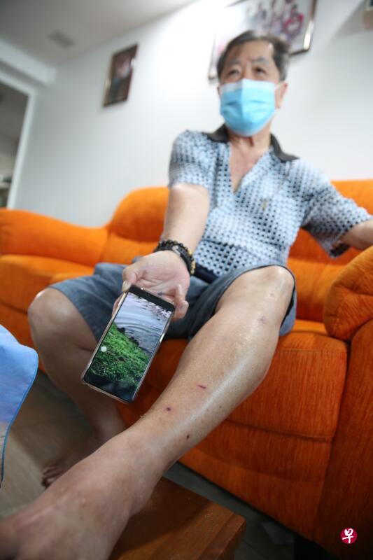 林富凤左腿被水獭咬伤。 林富凤左腿被水獭咬伤。