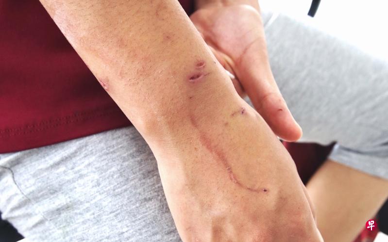 虽然已事过多日,但普伊手臂上的伤痕依然清晰可见。(陈佩敏摄) 虽然已事过多日,但普伊手臂上的伤痕依然清晰可见。(陈佩敏摄)