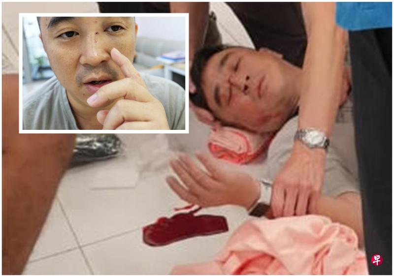 郭方荣被高尔夫球击中,鼻梁骨折歪了一边,左眼下方也有淤青。(庄耿文摄) 郭方荣被高尔夫球击中,鼻梁骨折歪了一边,左眼下方也有淤青。(庄耿文摄)