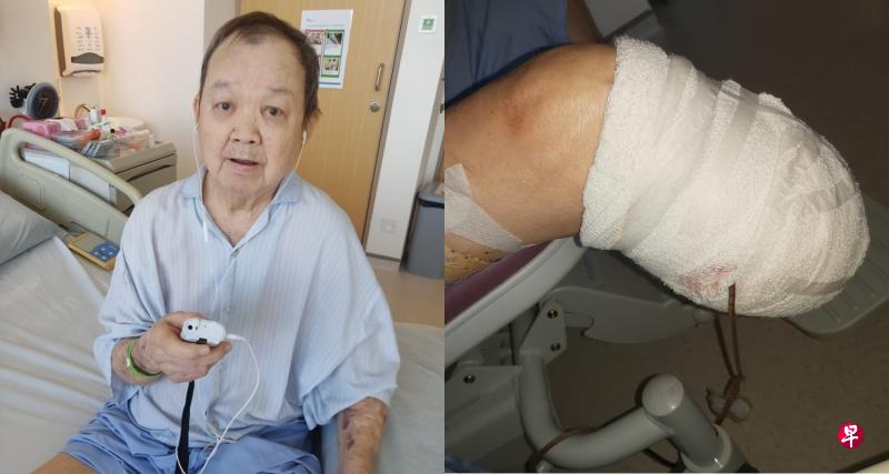 唐琥昨日接受三小时的截肢手术。右脚膝盖以下切除后,膝盖下仅剩一小部分,留做未来可装义肢。 (受访者提供图片) 唐琥昨日接受三小时的截肢手术。右脚膝盖以下切除后,膝盖下仅剩一小部分,留做未来可装义肢。 (受访者提供图片)