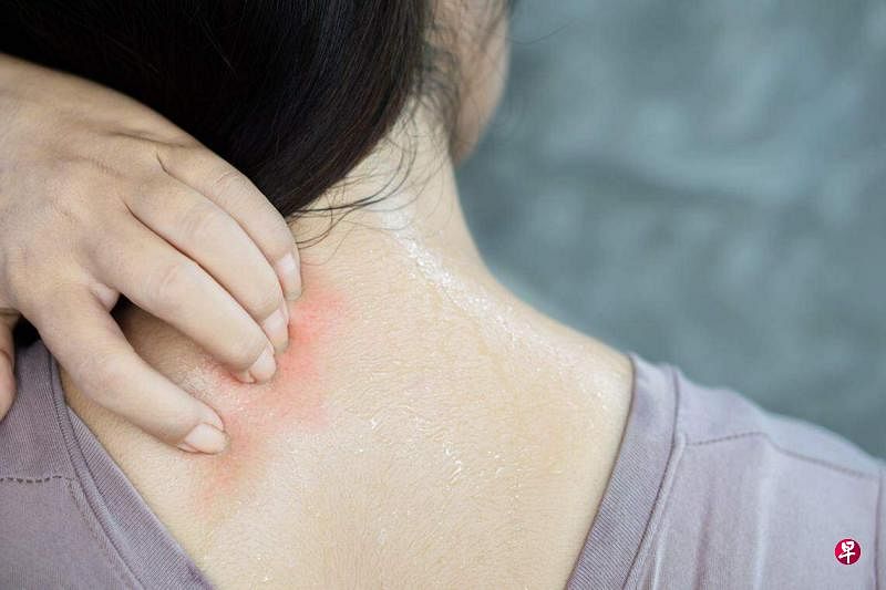 高温下出汗可能导致皮肤发痒，搔痒或会加重皮肤问题。（iStock图片）