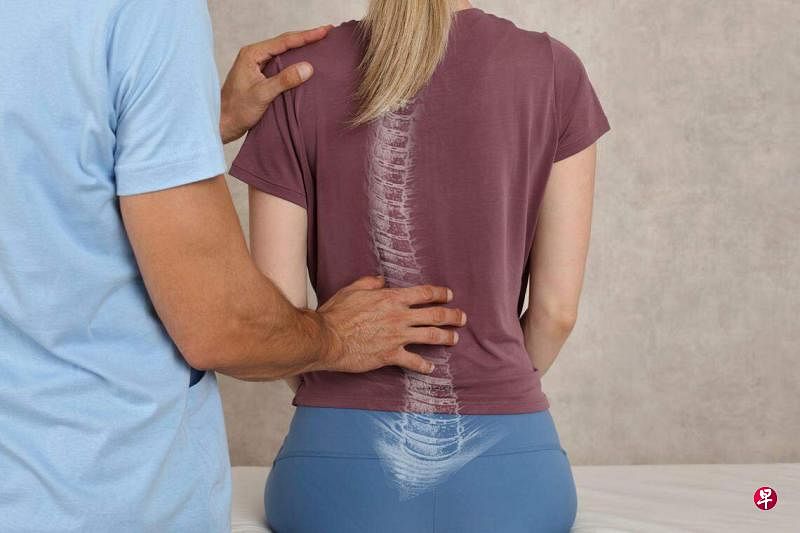脊椎侧弯是一种脊柱异常弯曲，特发性脊柱侧弯是常见的类型，病因至今不明。（iStock图片）