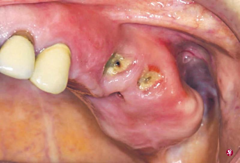 上颌骨粘膜下方骨面暴露。 上颌骨粘膜下方骨面暴露。