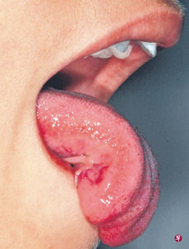 有舌系带短缩问题的人,舌尖没法伸直。(照片由医生提供) 有舌系带短缩问题的人,舌尖没法伸直。(照片由医生提供)