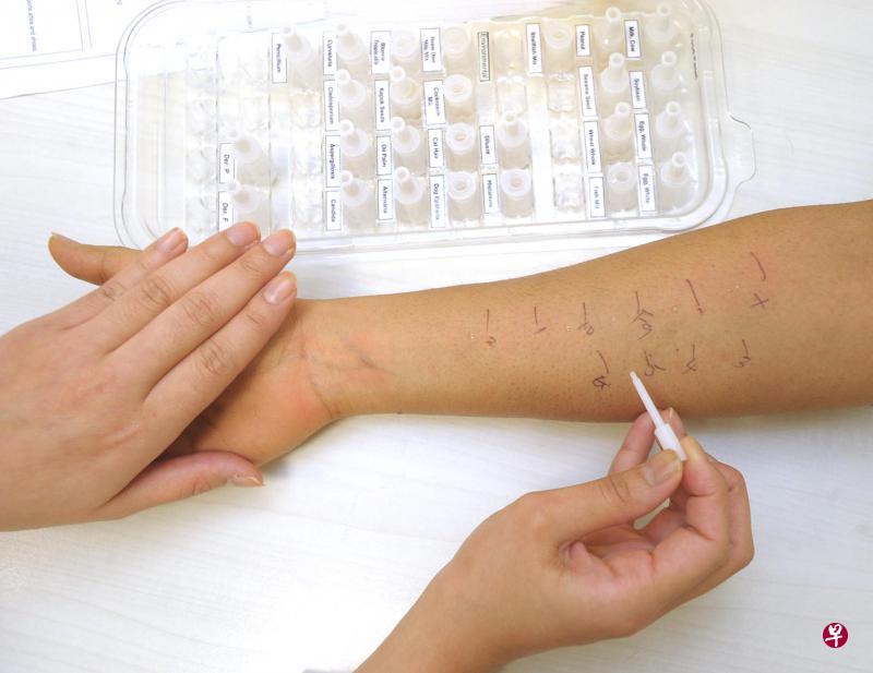 让孩子接受皮肤点刺测试(skin prick test) ,可验出是否对某种物质过敏。(档案照) 让孩子接受皮肤点刺测试(skin prick test) ,可验出是否对某种物质过敏。(档案照)