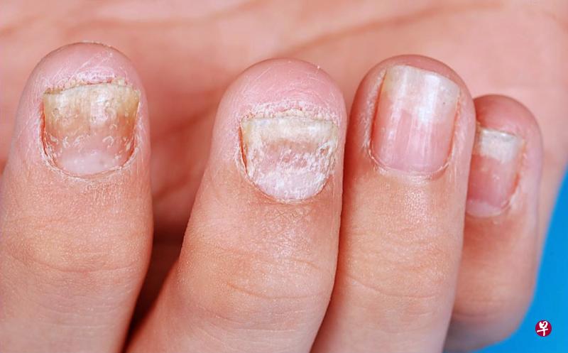 留意指甲,提早预防疾病。(档案照) 留意指甲,提早预防疾病。(档案照)