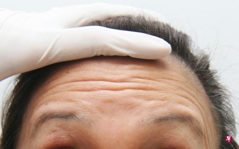 常皱眉,易产生抬头纹。(档案照) 常皱眉,易产生抬头纹。(档案照)