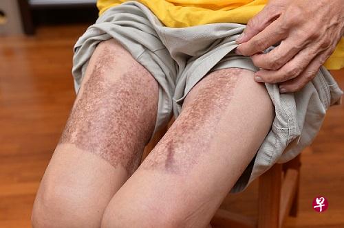 医生从黄先生的大腿取皮,如今还留下骇人的伤疤。 医生从黄先生的大腿取皮,如今还留下骇人的伤疤。