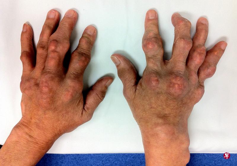 痛风(Gout)的典型症状之一:手上浮凸尿酸肿结。(图\国大医院) 痛风(Gout)的典型症状之一:手上浮凸尿酸肿结。(图\国大医院)