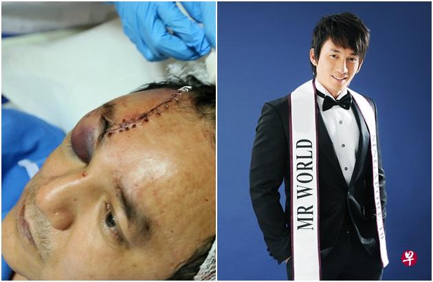 左图:遭殴打的德士司机李友财已动手术接回受损神经线,并缝了10多针。(档案照)右图:被告胡汉雄在2010年曾是新加坡世界先生,也是模特儿公司老板。(档案照) 左图:遭殴打的德士司机李友财已动手术接回受损神经线,并缝了10多针。(档案照)右图:被告胡汉雄在2010年曾是新加坡世界先生,也是模特儿公司老板。(档案照)