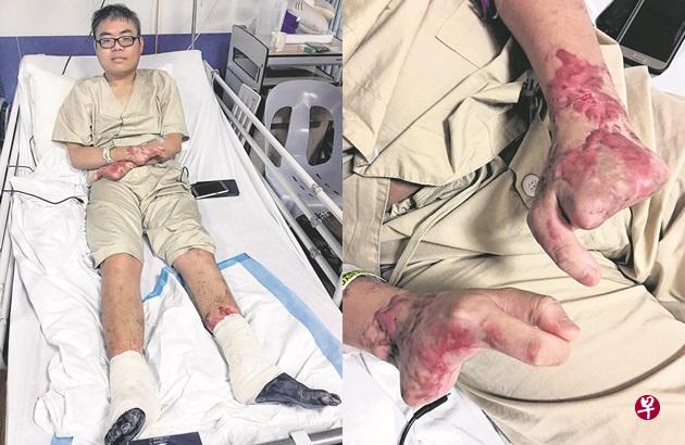 谢智勇在今天下午进行手术,截除已发黑的小腿。(受访者提供) 谢智勇在今天下午进行手术,截除已发黑的小腿。(受访者提供)