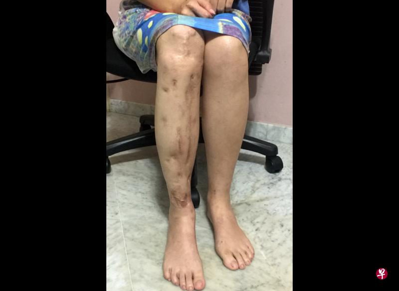 女董事叶文凤的右腿在车祸中受重伤,至今仍未痊愈。 女董事叶文凤的右腿在车祸中受重伤,至今仍未痊愈。
