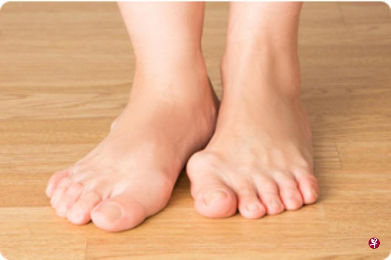 拇趾囊肿胀是指拇趾向外倾斜的一种畸形症状。(互联网) 拇趾囊肿胀是指拇趾向外倾斜的一种畸形症状。(互联网)