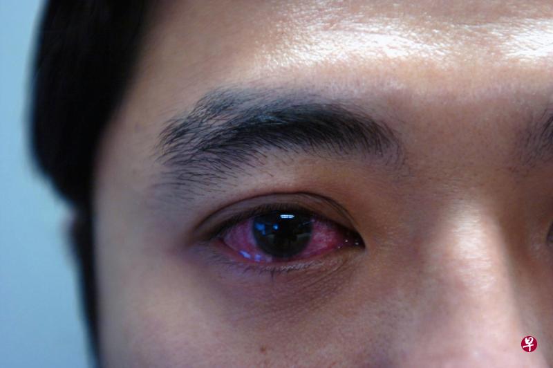 红眼症的最常见导因是病毒感染。（档案照）