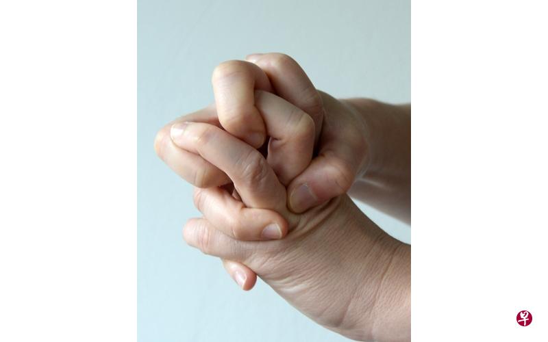 “弹响指”患者的手指僵硬,甚至“卡住”,难以屈伸。 “弹响指”患者的手指僵硬,甚至“卡住”,难以屈伸。