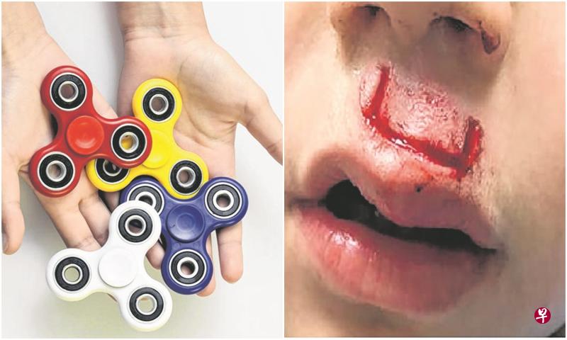 左图:近期在本地流行的玩具“指尖陀螺”。(档案照)右图:男童嘴唇上人中部位被飞出的碎片划出凹形血口。(互联网) 左图:近期在本地流行的玩具“指尖陀螺”。(档案照)右图:男童嘴唇上人中部位被飞出的碎片划出凹形血口。(互联网)