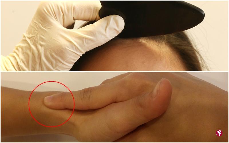 刮痧及揉列缺穴。 刮痧及揉列缺穴。