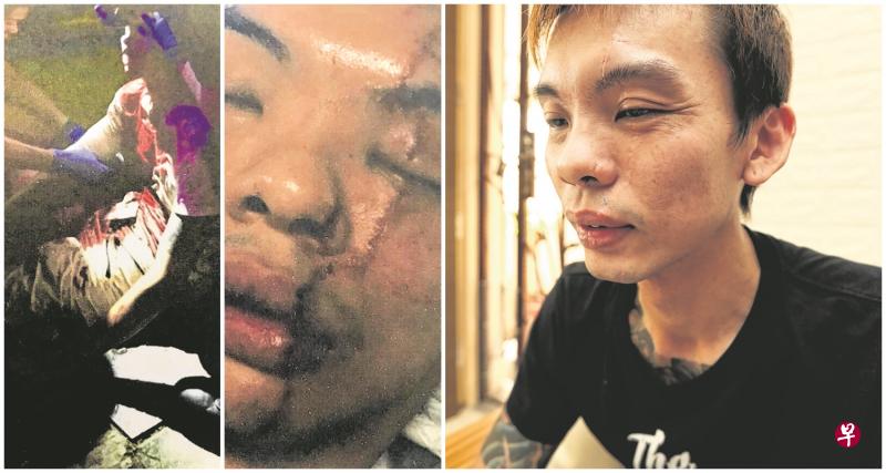 吕霆毅当时全身浴血倒地不起,醒来后发现脸上留有10公分长的疤痕。 吕霆毅当时全身浴血倒地不起,醒来后发现脸上留有10公分长的疤痕。