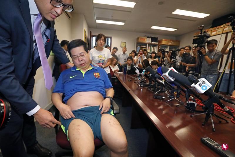 香港民主党成员林子健遭不明身份人士禁锢、殴打与恐吓,他昨天召开记者会诉说遭遇,并展示被人用钉书钉钉上约10个“十字架”的双腿。(路透社) 香港民主党成员林子健遭不明身份人士禁锢、殴打与恐吓,他昨天召开记者会诉说遭遇,并展示被人用钉书钉钉上约10个“十字架”的双腿。(路透社)