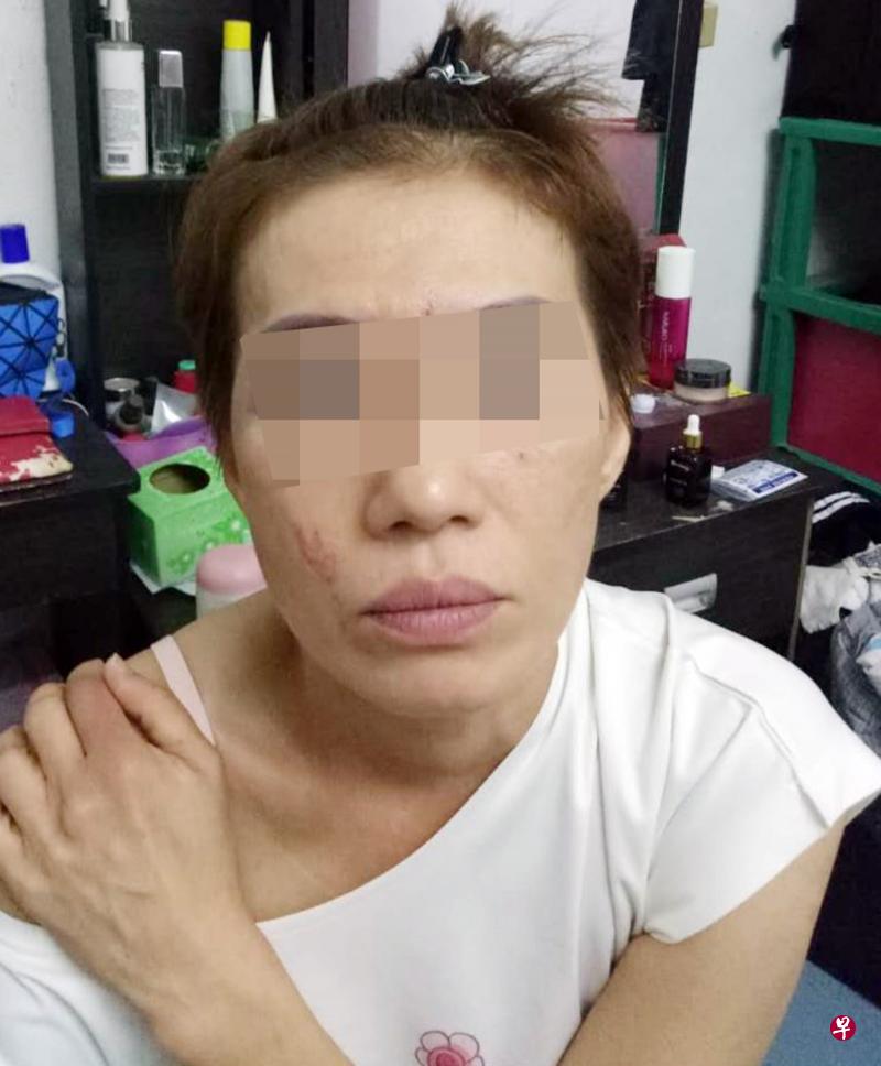 李女士(图)申诉被文身男乱拳打伤,还被抓伤。(受访者提供) 李女士(图)申诉被文身男乱拳打伤,还被抓伤。(受访者提供)