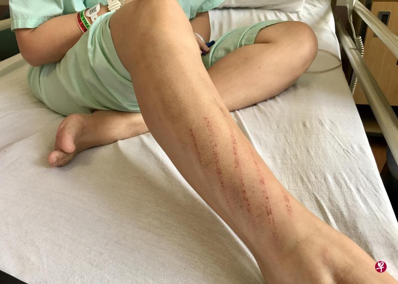 刘女士右腿擦伤。 刘女士右腿擦伤。