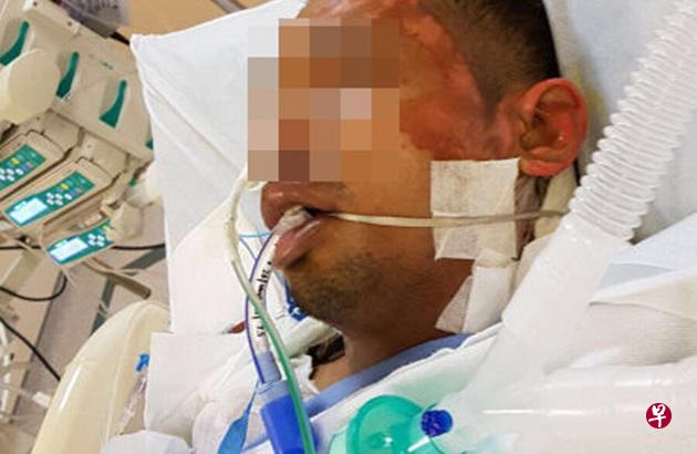 里兹旺全身30%烧伤,必须接受植皮手术。(家属提供) 里兹旺全身30%烧伤,必须接受植皮手术。(家属提供)