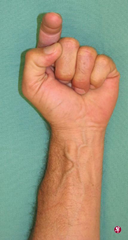 弹弓指问题须注射类固醇和麻醉药缓解症状。国大医院制定新医疗程序,为病患节省不必要的复诊。(国大医院提供) 弹弓指问题须注射类固醇和麻醉药缓解症状。国大医院制定新医疗程序,为病患节省不必要的复诊。(国大医院提供)