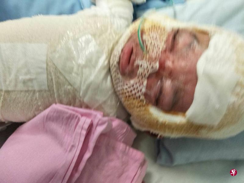 宝宝被热粥严重烫伤,必须动手术。(取自面簿) 宝宝被热粥严重烫伤,必须动手术。(取自面簿)