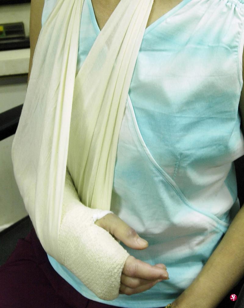 骨折后患处一般需包石膏。(档案照) 骨折后患处一般需包石膏。(档案照)