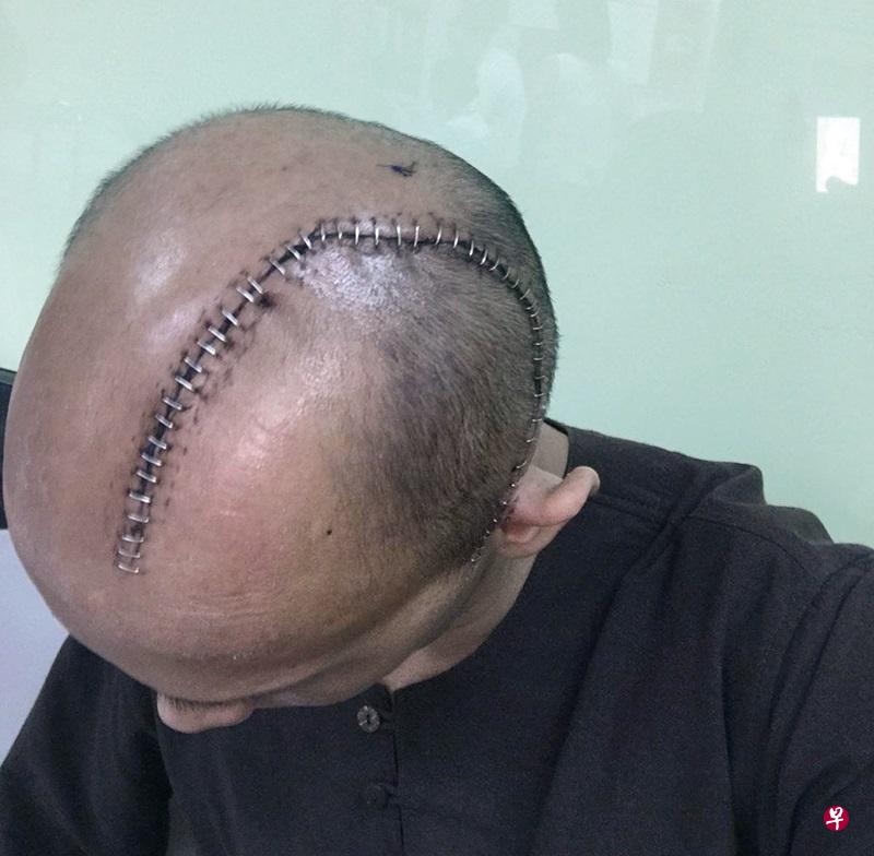 人造头壳用铁钉缝合,令人触目惊心。(受访者提供) 人造头壳用铁钉缝合,令人触目惊心。(受访者提供)