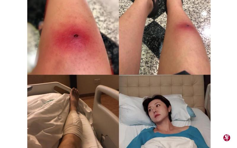 权怡凤选择缝合伤口,她担心会发炎后再爆开。(Instagram图) 权怡凤选择缝合伤口,她担心会发炎后再爆开。(Instagram图)