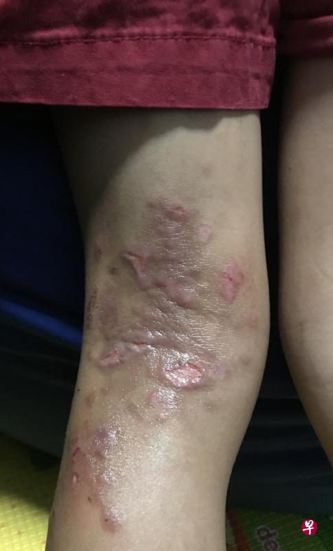 只要有医生的良好监督,用类固醇来治疗湿疹类的异位性皮肤炎是安全的。(莱佛士医院提供) 只要有医生的良好监督,用类固醇来治疗湿疹类的异位性皮肤炎是安全的。(莱佛士医院提供)