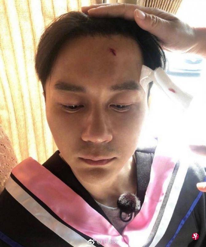 李晨的额头受伤。 李晨的额头受伤。