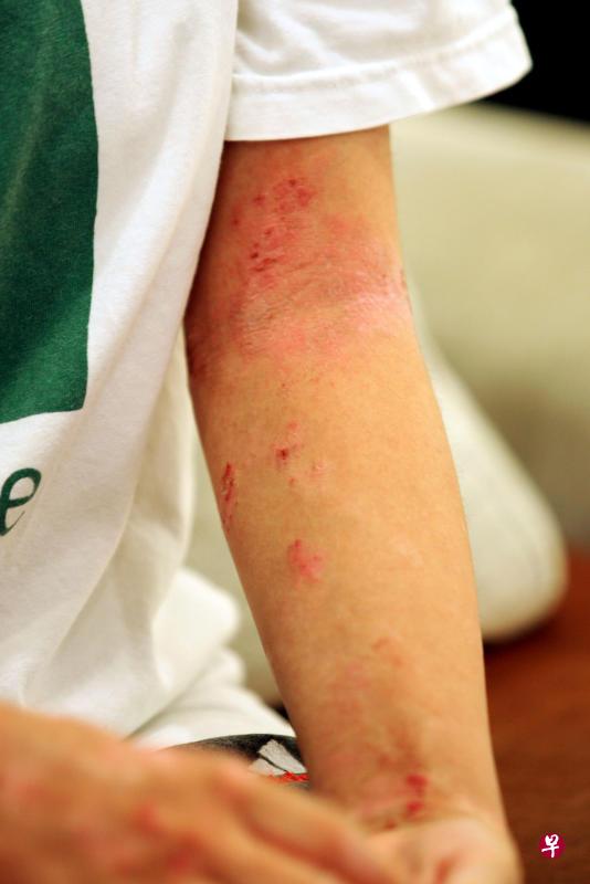 湿疹不会传染,但对患者的身心有显著影响。(档案照) 湿疹不会传染,但对患者的身心有显著影响。(档案照)