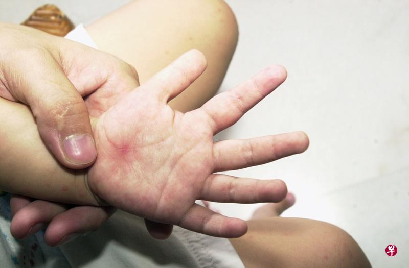 手脚出疹、嘴巴生疮是手足口症的常见症状。(档案照) 手脚出疹、嘴巴生疮是手足口症的常见症状。(档案照)