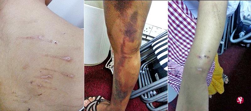 女佣多处留下严重淤伤。(陈思源 摄) 女佣多处留下严重淤伤。(陈思源 摄)
