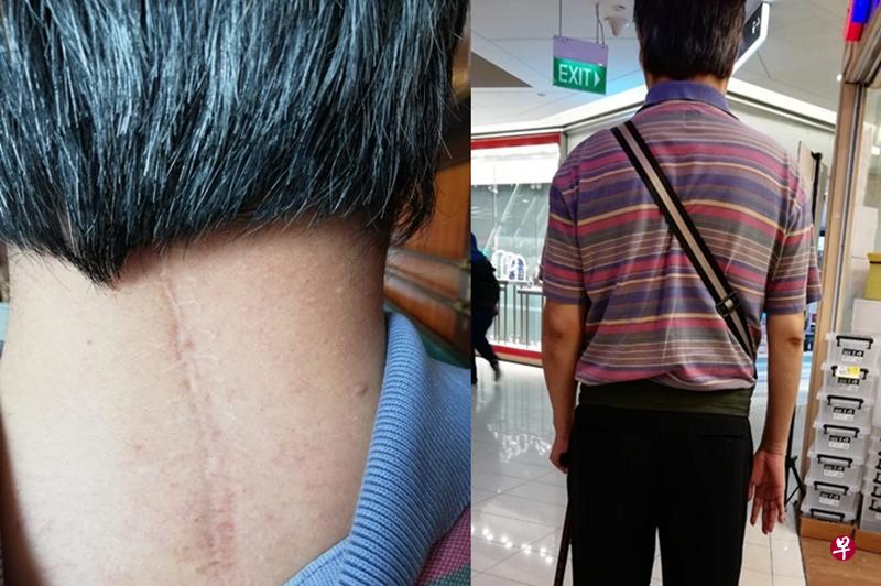 苏健昌的后颈因手术留下伤疤(左图)。物理治疗让苏健昌终于能够站起来用拐杖走路。(受访者提供) 苏健昌的后颈因手术留下伤疤(左图)。物理治疗让苏健昌终于能够站起来用拐杖走路。(受访者提供)