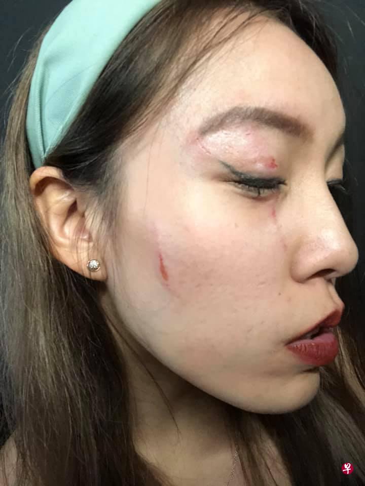 陈施绮眼周、脸部及脖子都有抓痕。(受访者提供) 陈施绮眼周、脸部及脖子都有抓痕。(受访者提供)
