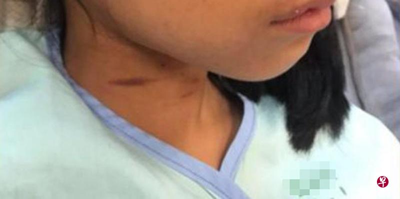 女童颈项仍可见勒痕。(受访者提供) 女童颈项仍可见勒痕。(受访者提供)