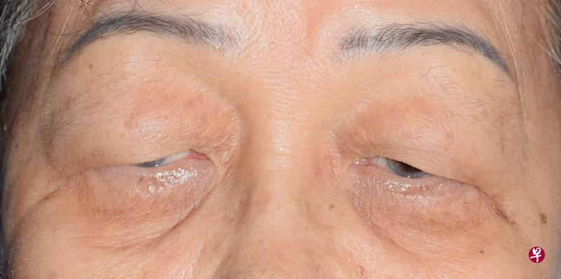 同时有老年性眼睑浮肿与上眼睑下垂的情况。(图片由国大医院提供) 同时有老年性眼睑浮肿与上眼睑下垂的情况。(图片由国大医院提供)