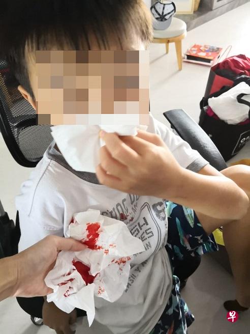 儿子鼻血流血不止,吓坏母亲。(受访者提供) 儿子鼻血流血不止,吓坏母亲。(受访者提供)
